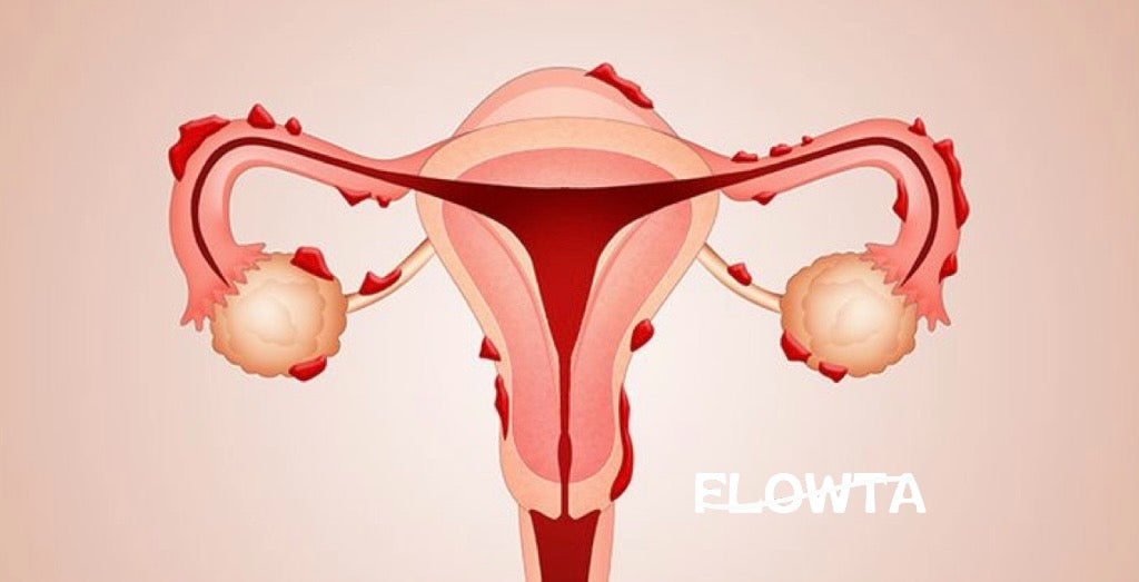 Endometriosis and Menstruation